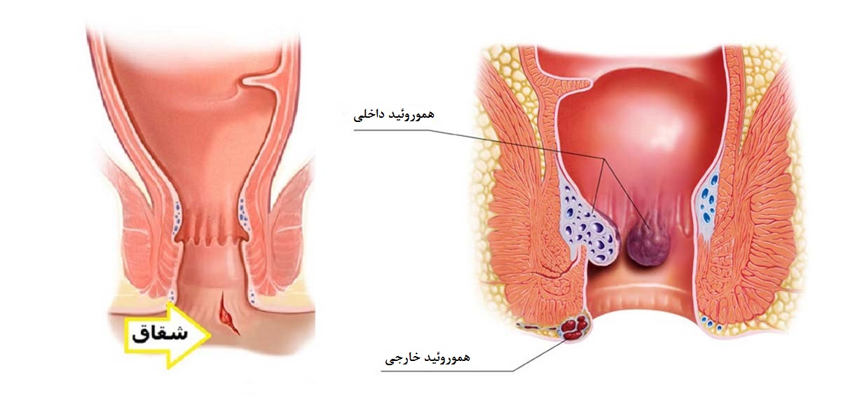 همورئید