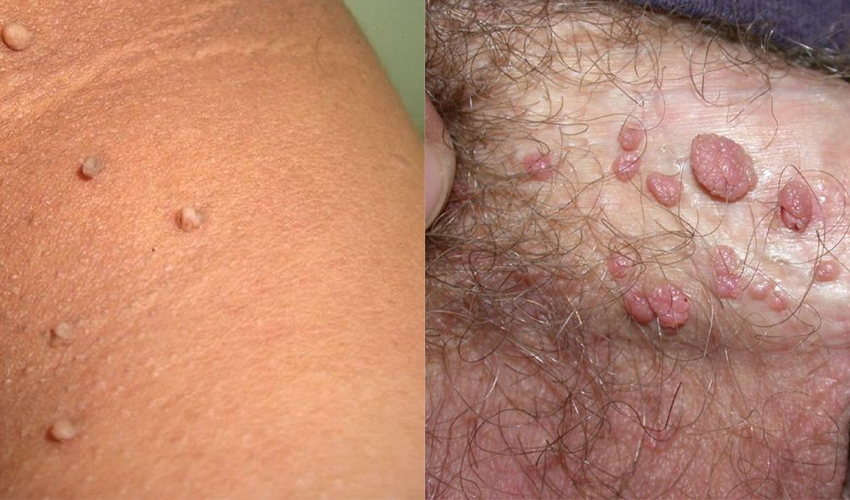 [تصویر:  differences-between-genital-warts-and-slin-tags.jpg]