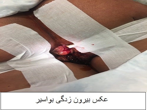 عکس بیرون زدگی بواسیر
