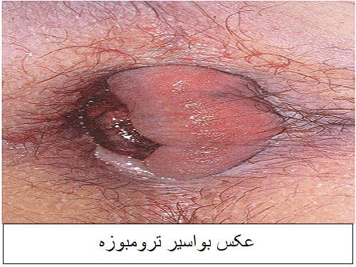 عکس بواسیر ترومبوزه