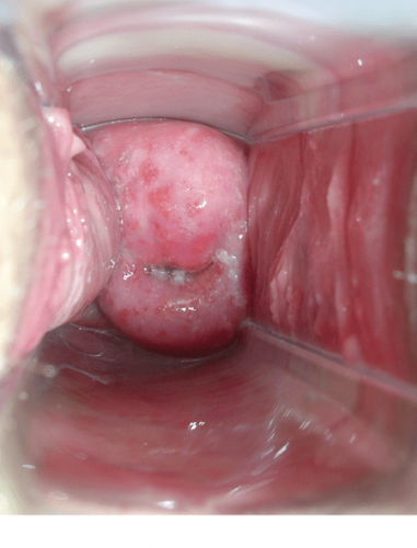 عفونت دهانه رحم در اثر بیماری تریکومونیازیس