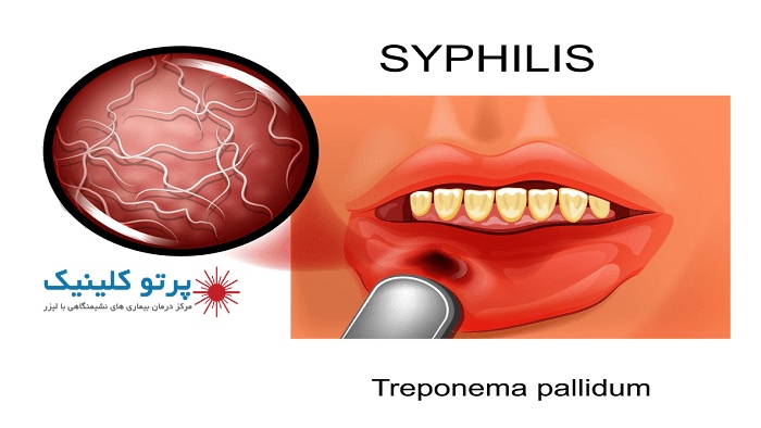 انواع بیماری های مقاربتی در زنان و مردان با عکس پرتو کلینیک