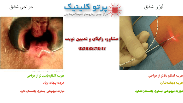 مقایسه هزینه عمل شقاق و لیزر