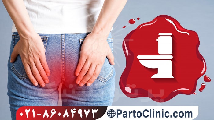 علت خونریزی مقعدی بدون درد چیست