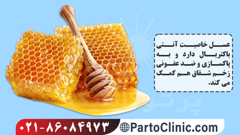 درمان شقاق با عسل