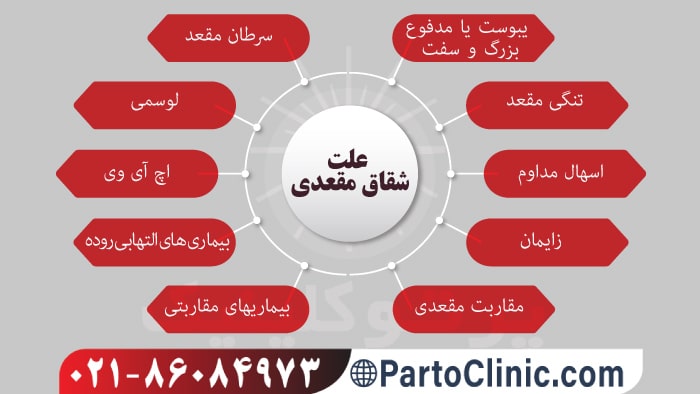 علت شقاق مقعدی چیست