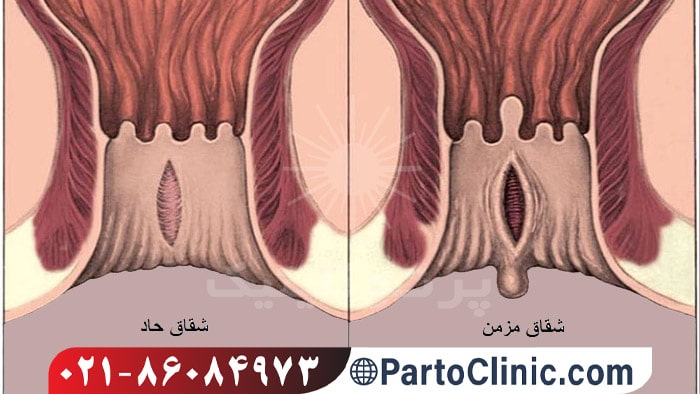 انواع شقاق مقعدی