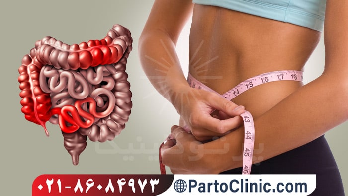 روده تحریک پذیر و لاغری