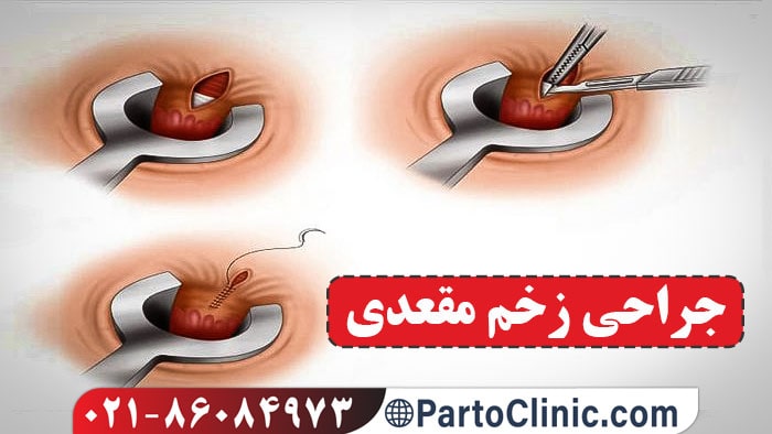 جراحی زخم مقعدی