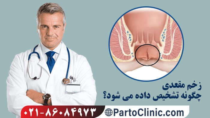علائم زخم مقعدی