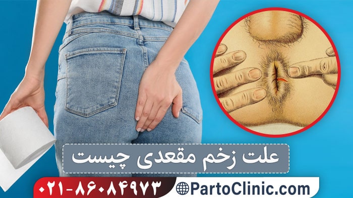 علت زخم مقعد
