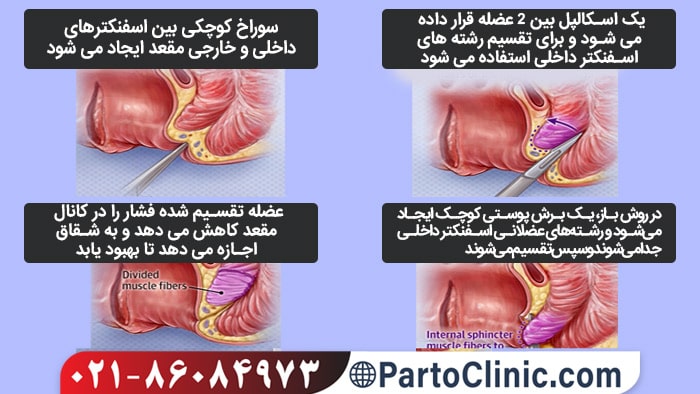 تصویر: https://partoclinic.com/wp-content/uploads/2024/04/surgery-sphincterotomy-open.jpg