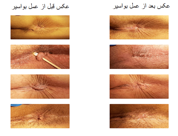عکس قبل و بعد از عمل بواسیر