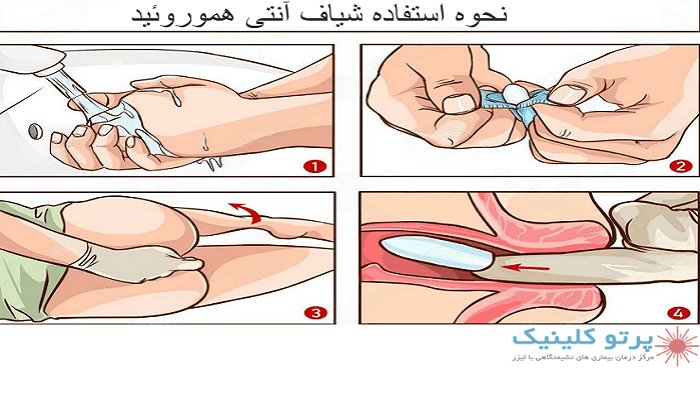 نحوه گذاشتن شیاف آنتی هموروئید