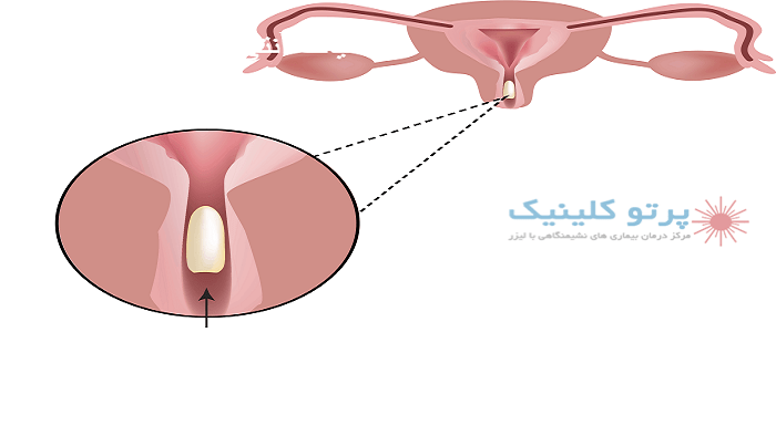 انواع شیاف آنتی هموروئید