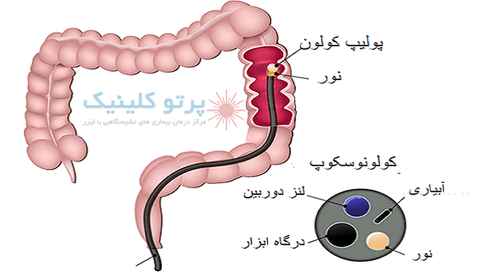 کولونوسکوپی چیست