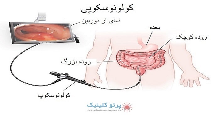 کولونوسکوپی چگونه انجام میشود