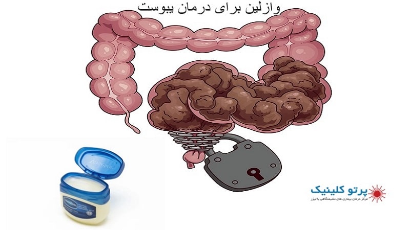 وازلین برای درمان یبوست