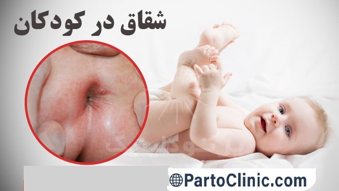 علت شقاق مقعدی در کودکان