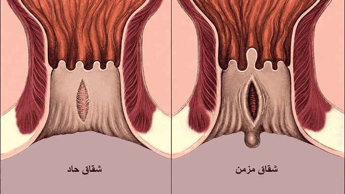 انواع شقاق مقعدی