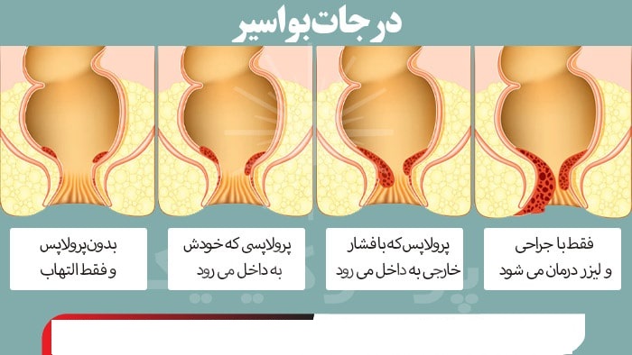 درجات بواسیر