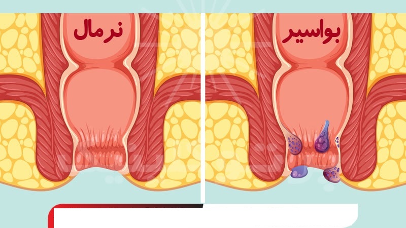 بواسیر یا هموروئید چیست